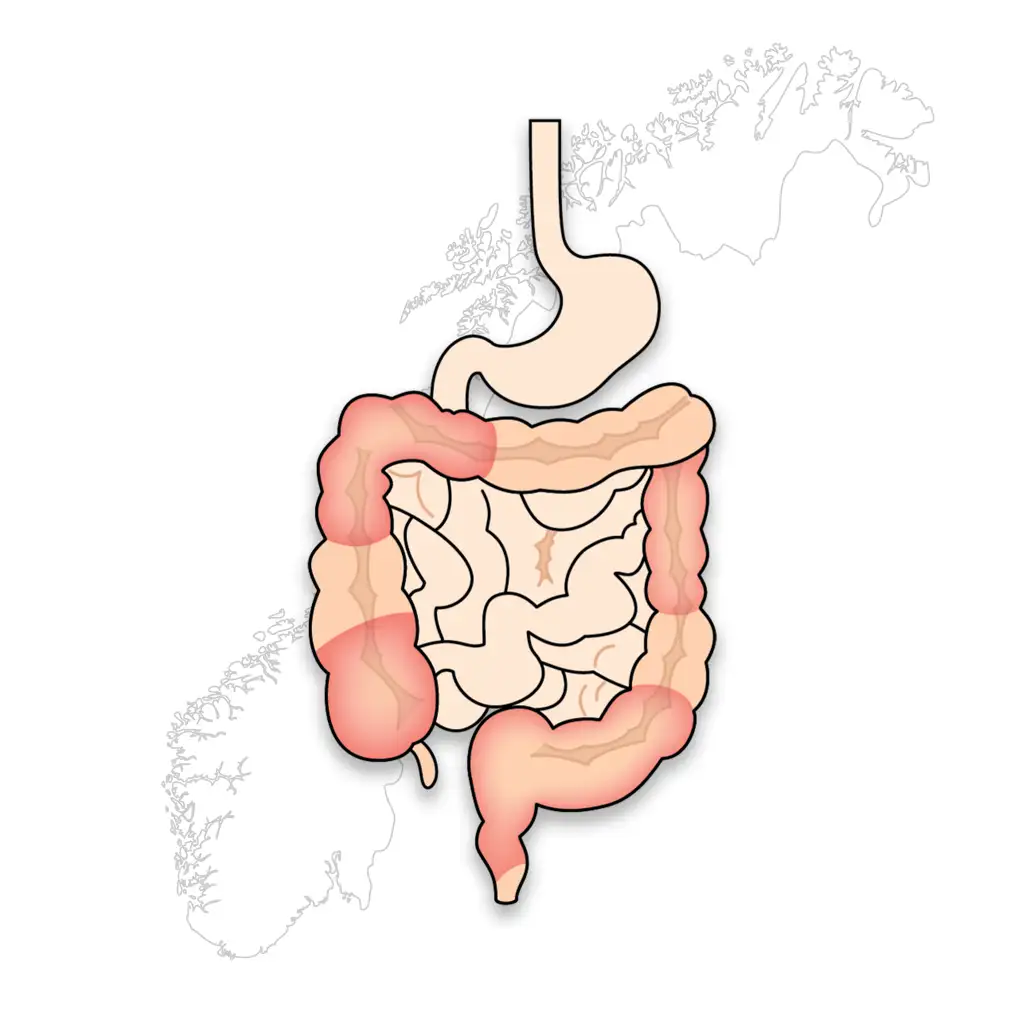 Illustrasjon tarm over kart fra Norge - NISG IBD